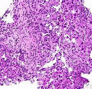 Image result for Adenocarcinoma in Situ Lung