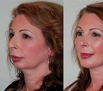 Image result for facial augmentation implants