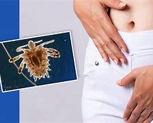 Image result for pubic lice treatments