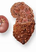 Image result for Complex Cyst On Kidney