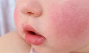 Image result for Red Warm Cheeks