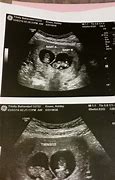 Image result for 14 Week Twin Ultrasound