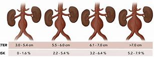 Image result for Abdominal Aortic Aneurysm Size