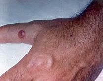 Image result for ORF Infection