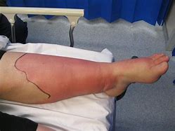 Image result for Leg Cellulitis Treatment Antibiotics