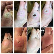 Image result for Plantar Wart Healing Stages
