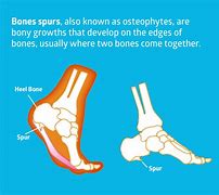 Image result for Baby Bone Spurs