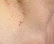 Image result for Plane Warts On Face