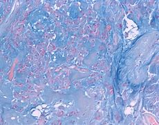 Image result for Meningioma Histology
