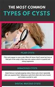 Image result for Types of Cysts On Skin