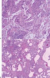 Image result for Surgical Lung Biopsy