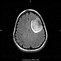 Image result for 2 Cm Brain Tumor