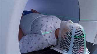 Image result for Radiation Therapy Head and Neck Cancer