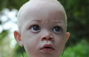 Image result for albinl