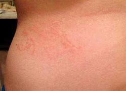 Image result for Scabies On Scalp