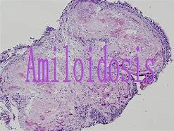 Image result for amilosis