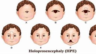 Image result for Holoprosencephaly