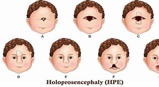 Image result for Alobar Holoprosencephaly Cyclopia
