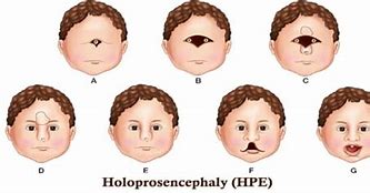 Image result for Holoanencephaly