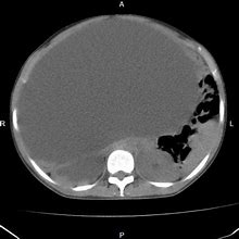 Image result for Ovarian Cyst On X-ray