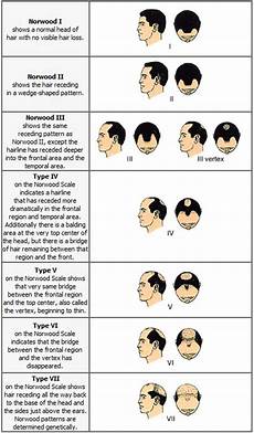 Cure Against Baldness Norwood Hamilton Scale Of