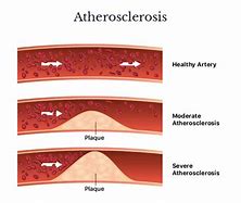 Image result for Severe Atherosclerosis
