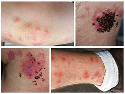Image result for Severe Bed Bug Bites
