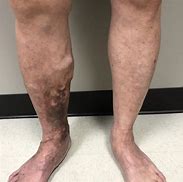 Image result for Discoloration On Lower Legs