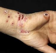 Image result for Pox Virus Molluscum