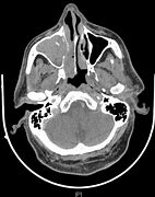 Image result for Inverted Papilloma Nose