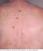 Image result for Brown Scaly Spots On Skin