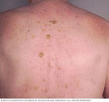 Image result for Seborrheic Keratosis Skin