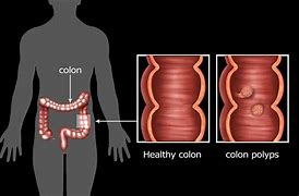 Image result for Average Size of Colon Polyps