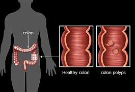 Image result for 20 Cm Polyp in Colon