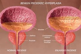 Image result for hiperplasia