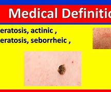 Image result for Actinic Keratosis Nose