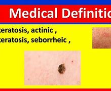 Image result for Liquid Nitrogen Reaction Face Actinic Keratosis