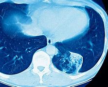 Image result for Lung Cancer MRI Scan