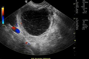 Image result for Hemorrhagic Cyst Ovary Ultrasound