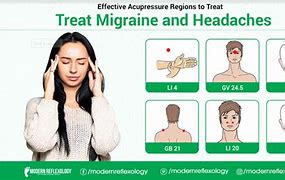Image result for Migraine Acupuncture