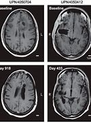 Image result for Glioblastoma End of Life Signs