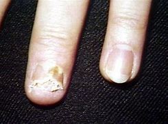 Image result for Wart Remuval