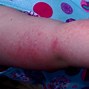 Image result for Allergic Reaction to Cherries