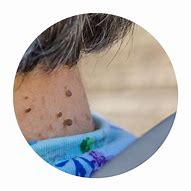 Image result for Papilloma Skin Tag