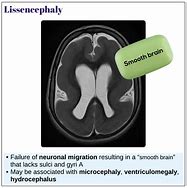 Image result for Lissencephaly Specialized Equipment