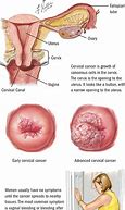 Image result for Advanced Cervical Cancer