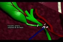 Image result for Roux En Y Biliary Bypass