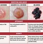 Image result for HPV Skin Cancer