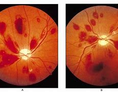 Image result for Anemia Retinopathy