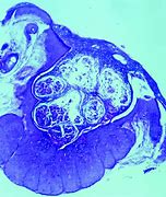 Image result for Molluscum Contagiosum Virus Lacks
